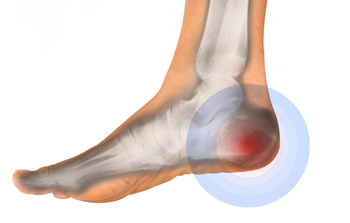 calcaneal pain in child