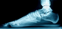 Understanding the Progression of Flat Feet in Adults