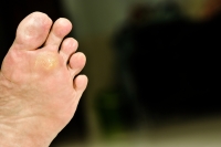 How Do I Know If I Have a Plantar Wart?