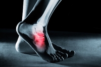 What’s the Treatment for Stress Fractures?
