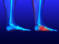 Flat Feet Can Affect Children and Adults