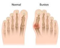 Bunions and Associated Problems