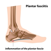 Treating Pain in the Plantar Fascia