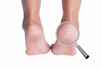 How to Find Mild Relief From Cracked Heels
