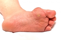 An Overview of Calluses and Corns